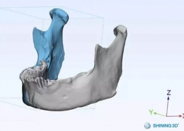 利用3D掃描及打印修復骨頭