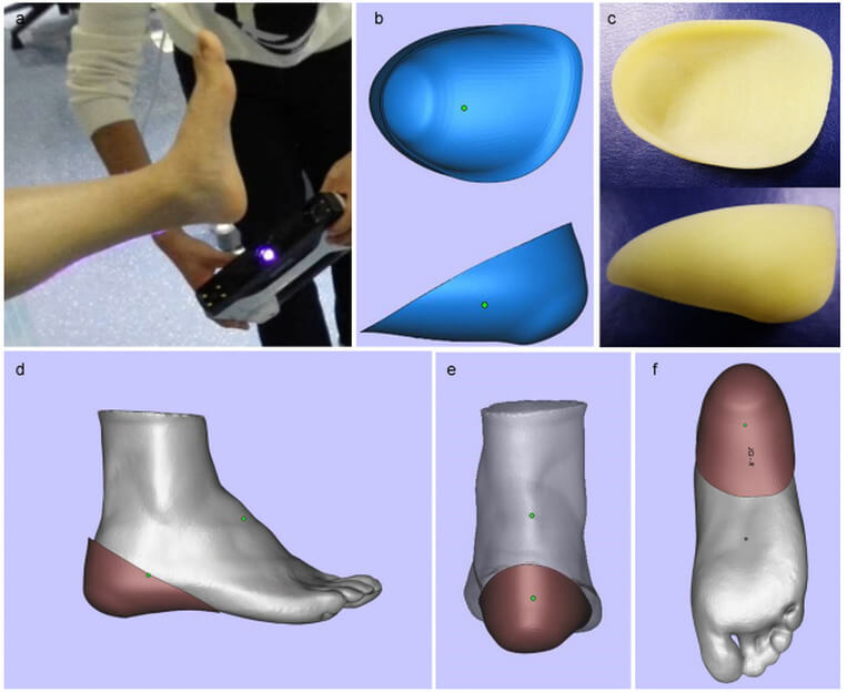 利用3D掃描器製作個性化護足設備