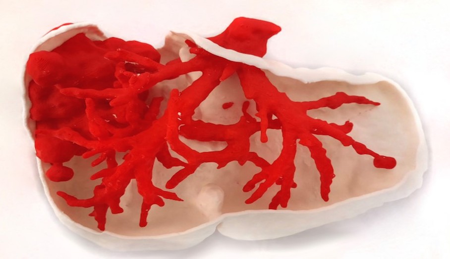 IDEX 3D打印技術如何協助Nari博士進行挽救生命的手術？1