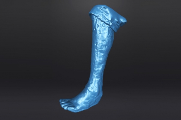 3D掃描技術幫助燒傷患者正常行走？ 2