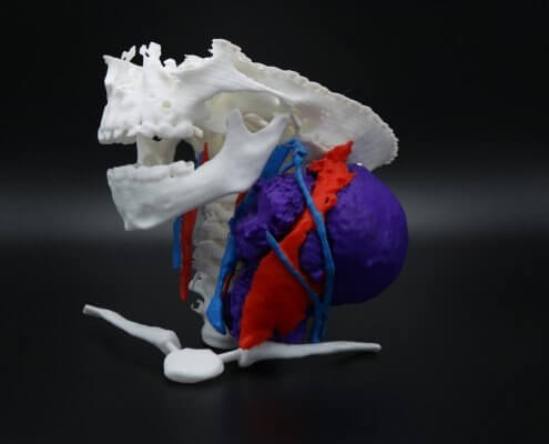 3D 打印之醫療模型及面部義肢