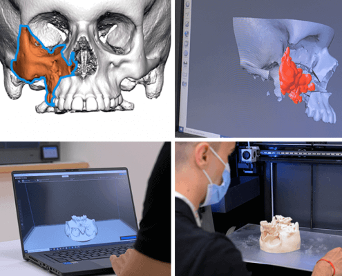 西班牙的兒童醫院3D打印解剖模型，為復雜手術的規劃和模擬