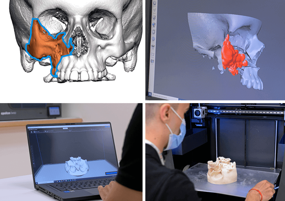 西班牙的兒童醫院3D打印解剖模型，為復雜手術的規劃和模擬